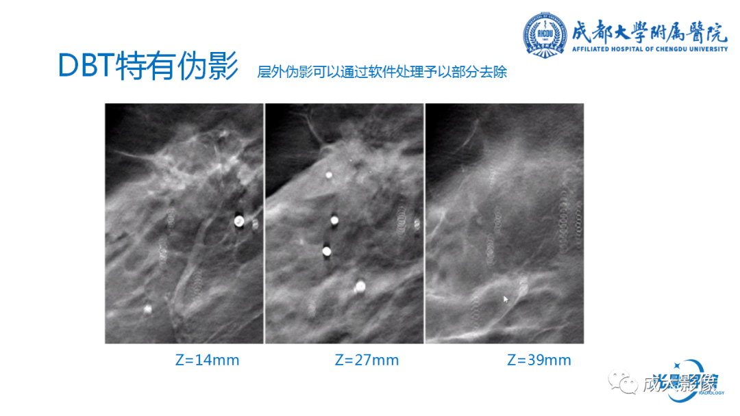 影像PPT - 【PPT】乳腺DBT初认识-43