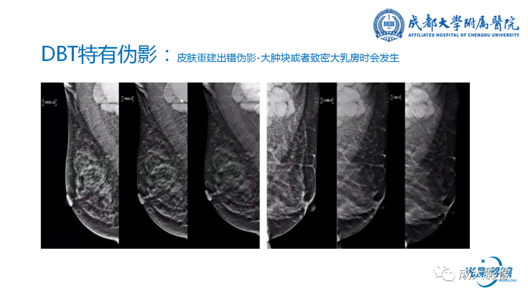 影像PPT - 【PPT】乳腺DBT初认识-44