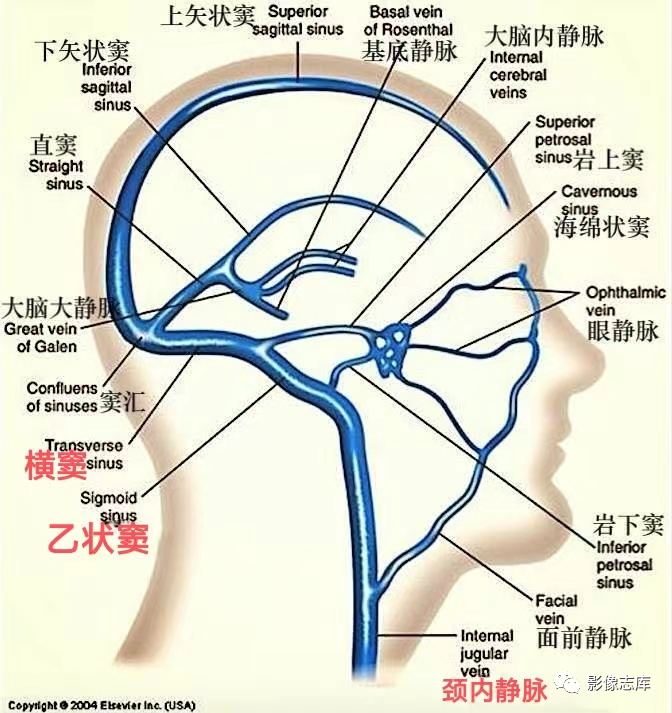 影像PPT - 耳朵听到心跳声—乙状窦憩室CT表现-1 影像PPT - 耳朵听到心跳声—乙状窦憩室CT表现-1