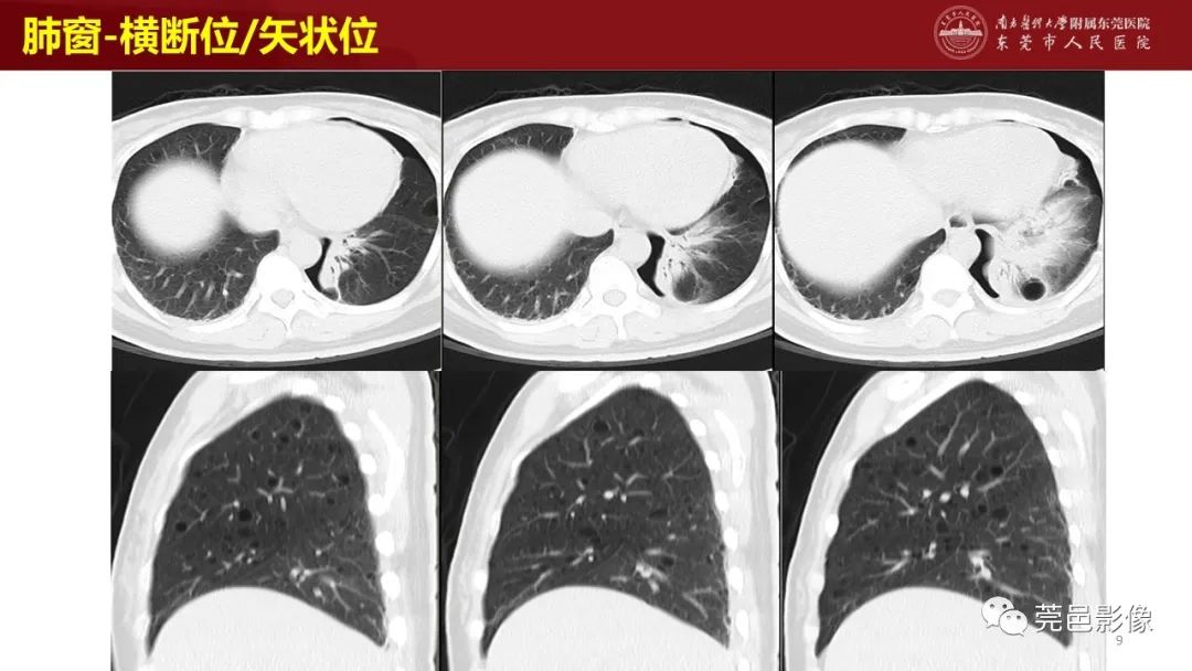 影像PPT - 【PPT】肺淋巴管肌瘤病影像诊断-7
