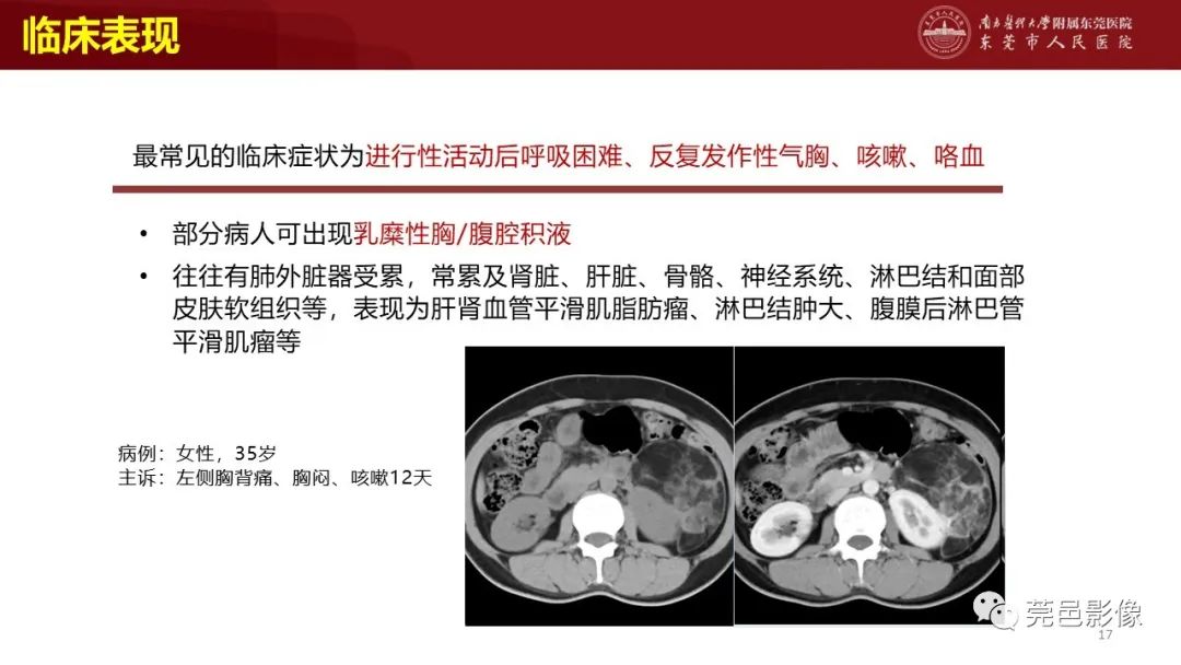 影像PPT - 【PPT】肺淋巴管肌瘤病影像诊断-15