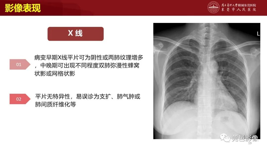 影像PPT - 【PPT】肺淋巴管肌瘤病影像诊断-17