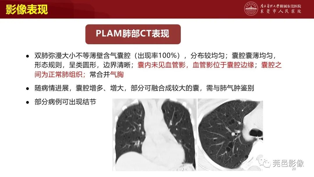 影像PPT - 【PPT】肺淋巴管肌瘤病影像诊断-18