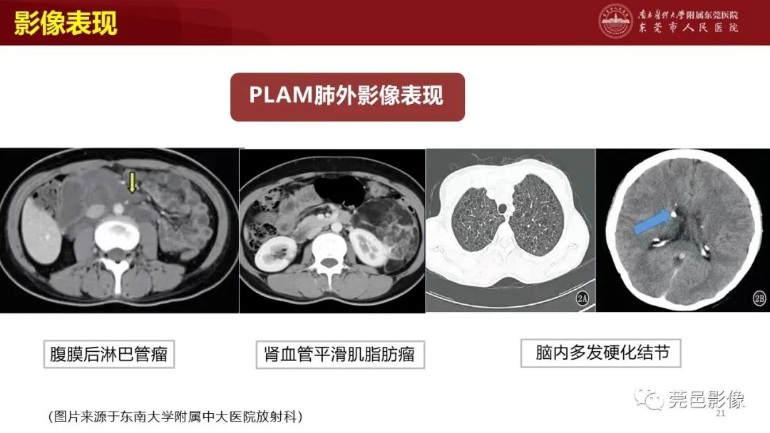 影像PPT - 【PPT】肺淋巴管肌瘤病影像诊断-19