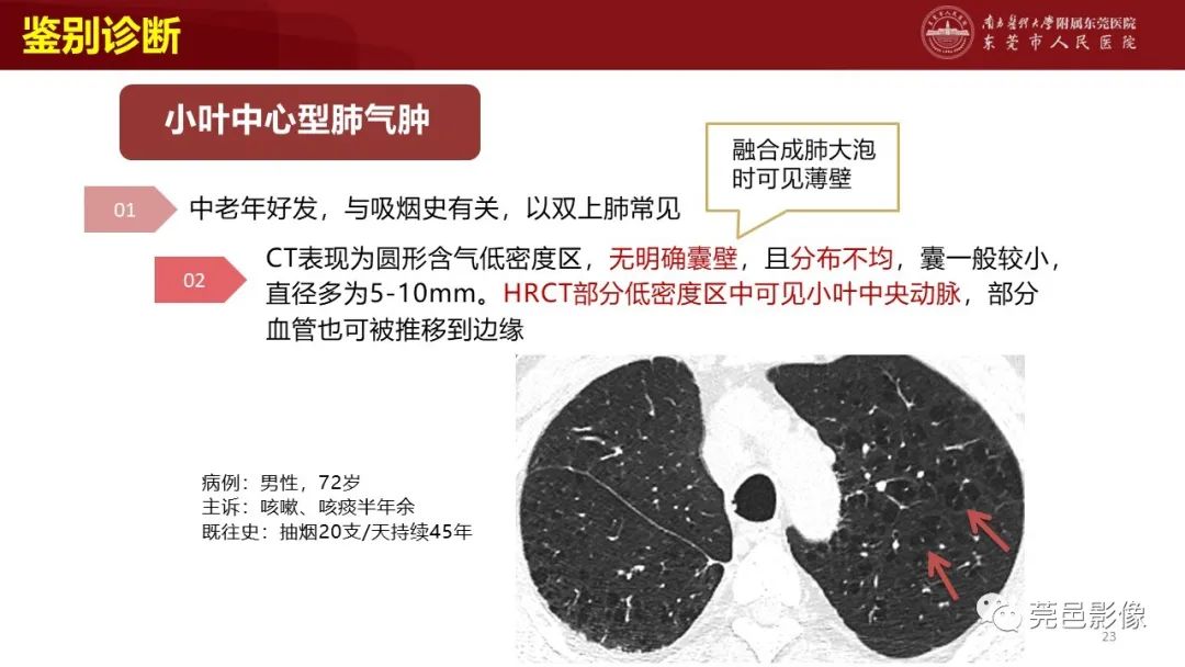 影像PPT - 【PPT】肺淋巴管肌瘤病影像诊断-21