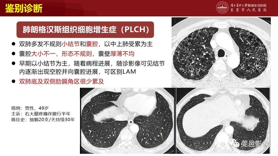影像PPT - 【PPT】肺淋巴管肌瘤病影像诊断-24