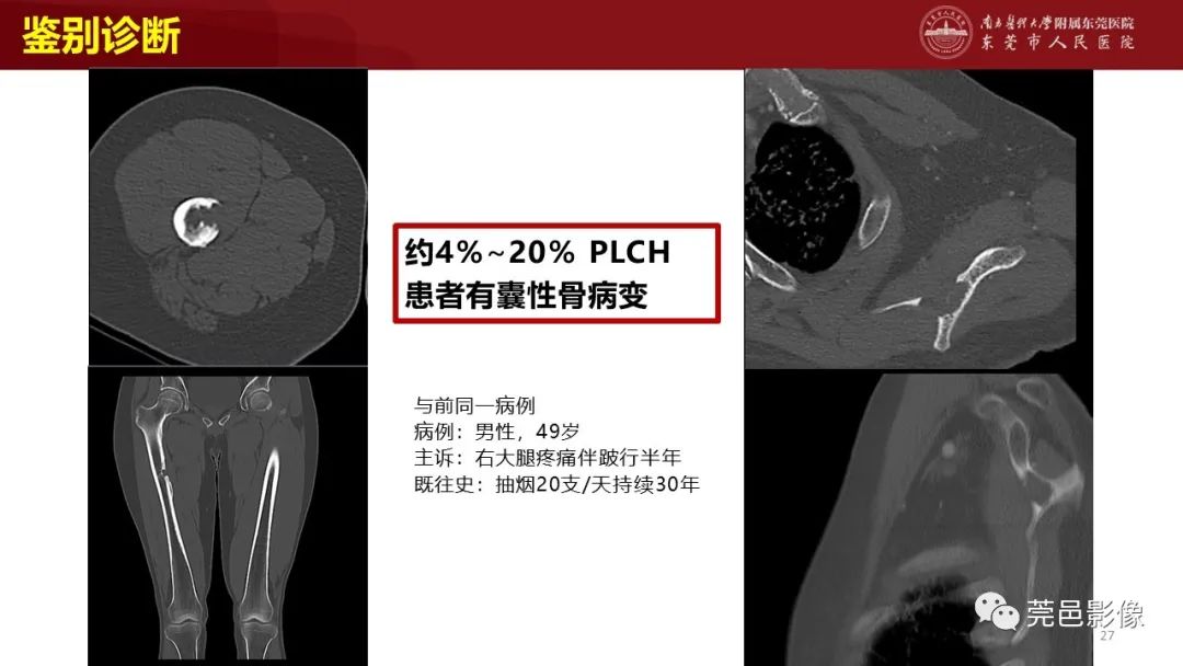 影像PPT - 【PPT】肺淋巴管肌瘤病影像诊断-25