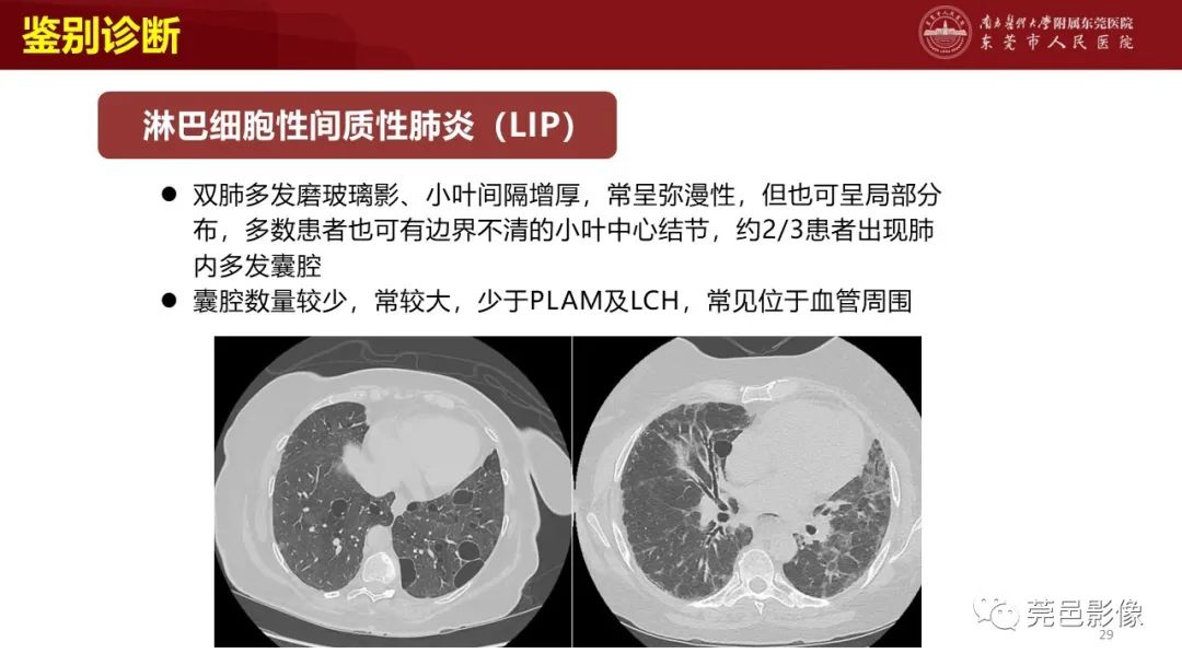 影像PPT - 【PPT】肺淋巴管肌瘤病影像诊断-27