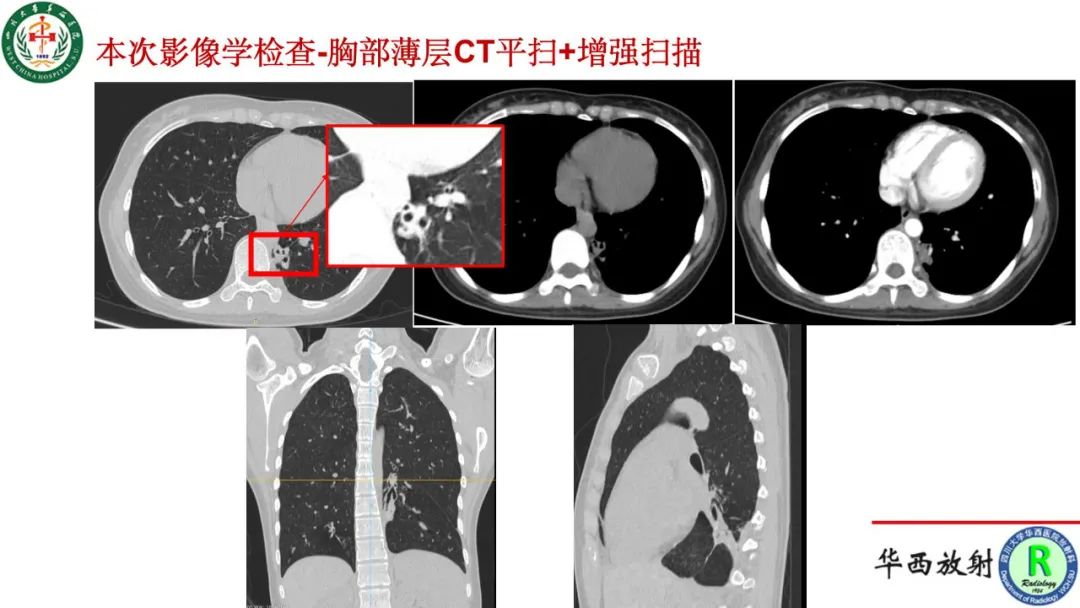 影像PPT - 【病例】肺脓肿诺卡菌病1例CT影像诊断及鉴别-4