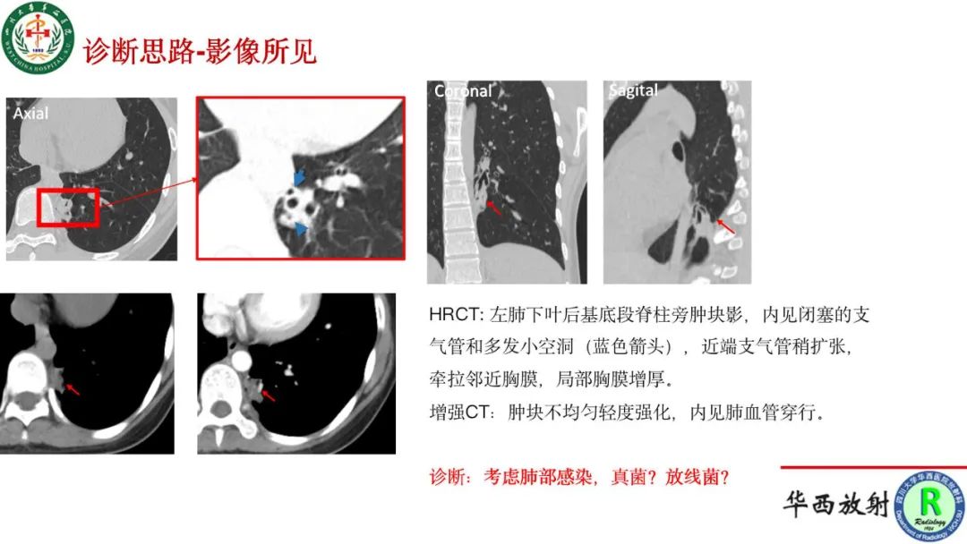 影像PPT - 【病例】肺脓肿诺卡菌病1例CT影像诊断及鉴别-6
