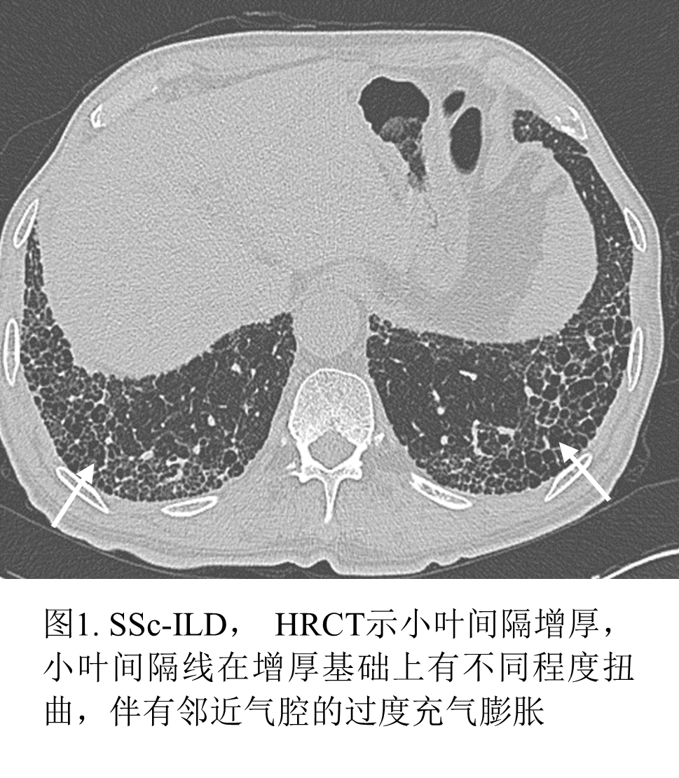 影像PPT - 系统性硬化症相关间质性肺炎-3 影像PPT - 系统性硬化症相关间质性肺炎-3