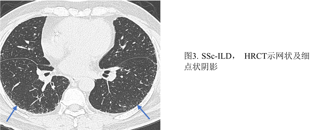 影像PPT - 系统性硬化症相关间质性肺炎-5 影像PPT - 系统性硬化症相关间质性肺炎-5