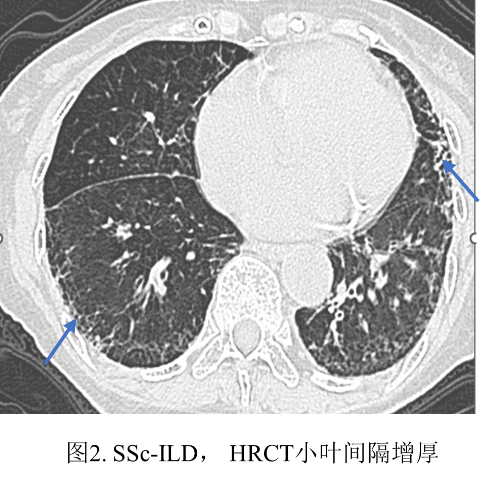 影像PPT - 系统性硬化症相关间质性肺炎-4 影像PPT - 系统性硬化症相关间质性肺炎-4