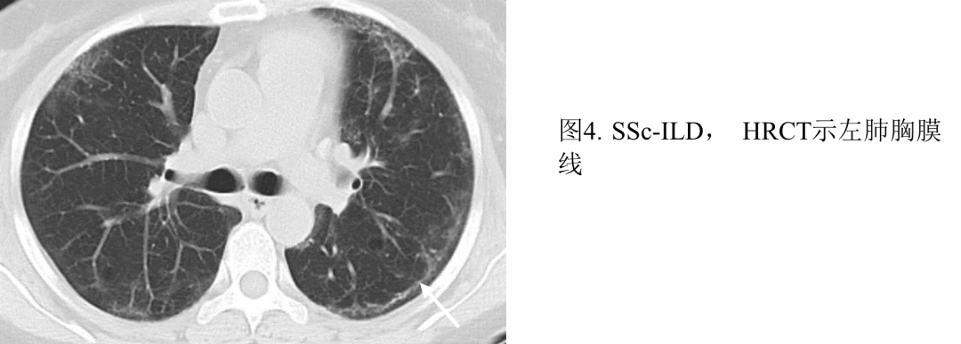 影像PPT - 系统性硬化症相关间质性肺炎-6 影像PPT - 系统性硬化症相关间质性肺炎-6