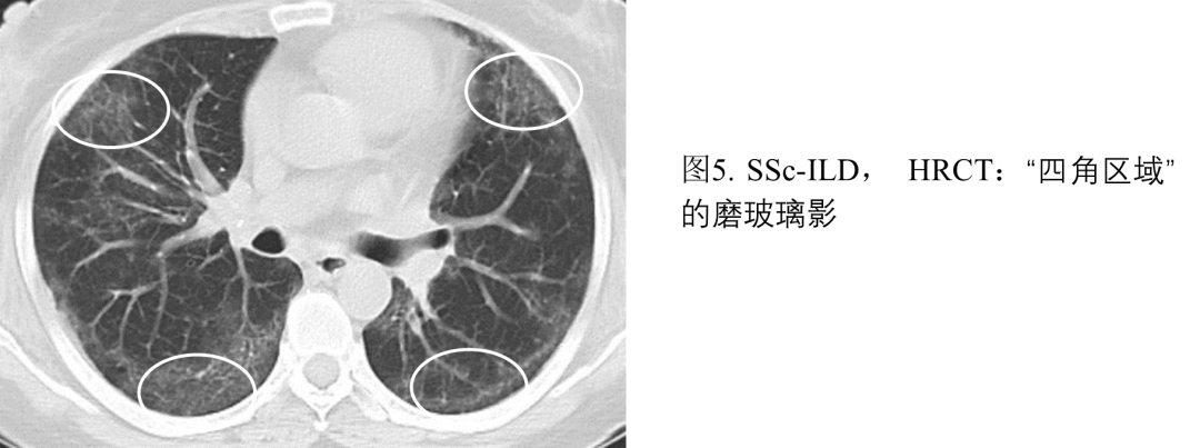 影像PPT - 系统性硬化症相关间质性肺炎-7 影像PPT - 系统性硬化症相关间质性肺炎-7