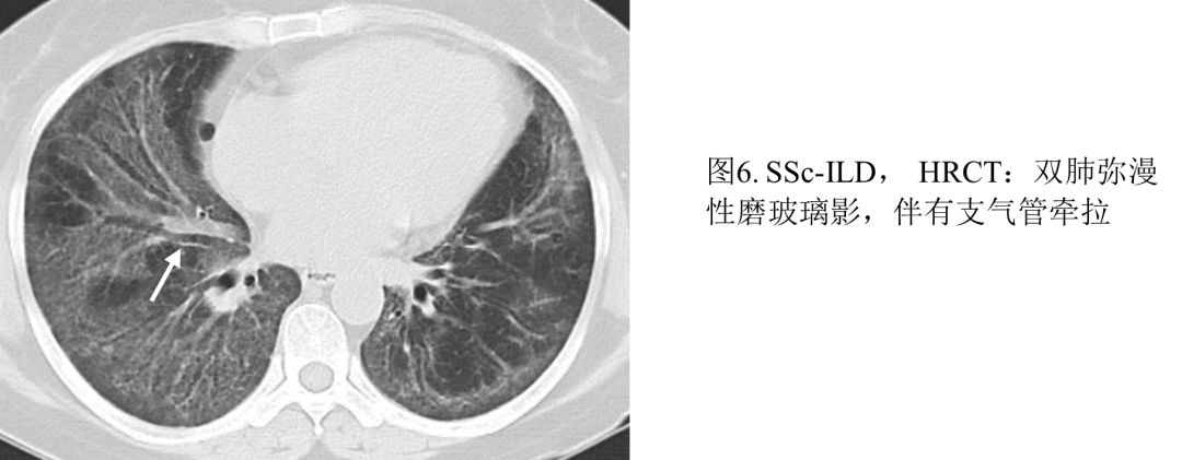 影像PPT - 系统性硬化症相关间质性肺炎-8 影像PPT - 系统性硬化症相关间质性肺炎-8