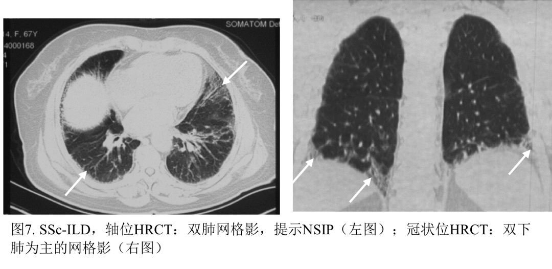 影像PPT - 系统性硬化症相关间质性肺炎-9 影像PPT - 系统性硬化症相关间质性肺炎-9