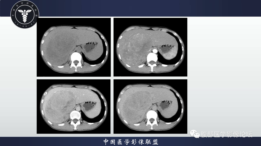 影像PPT - 【病例】肝细胞腺瘤1例CT及MR影像诊断-4