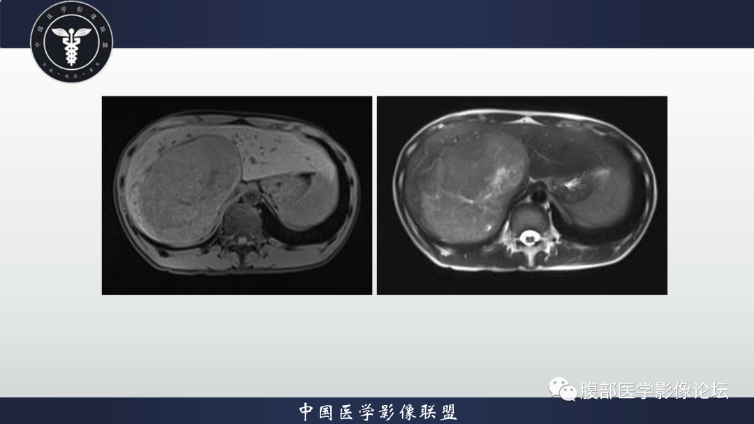 影像PPT - 【病例】肝细胞腺瘤1例CT及MR影像诊断-5