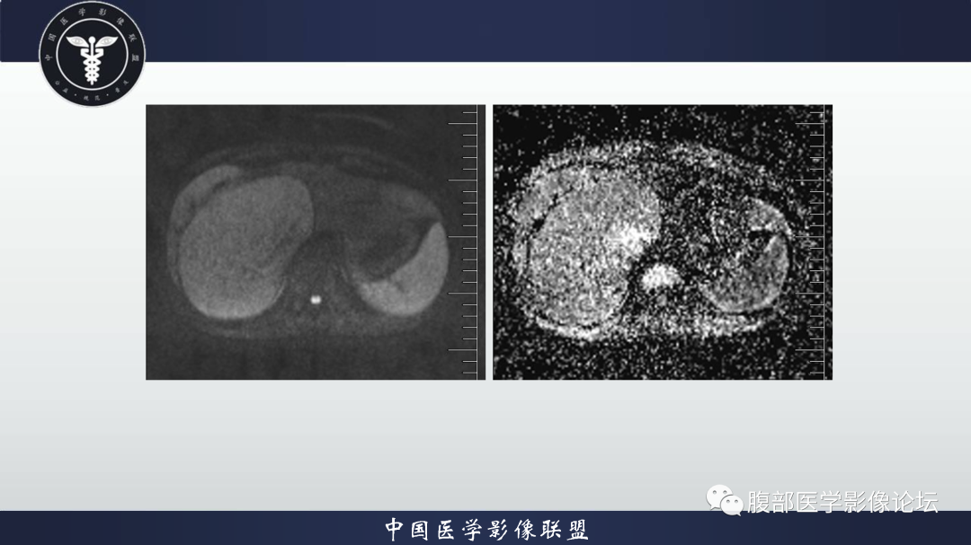 影像PPT - 【病例】肝细胞腺瘤1例CT及MR影像诊断-6