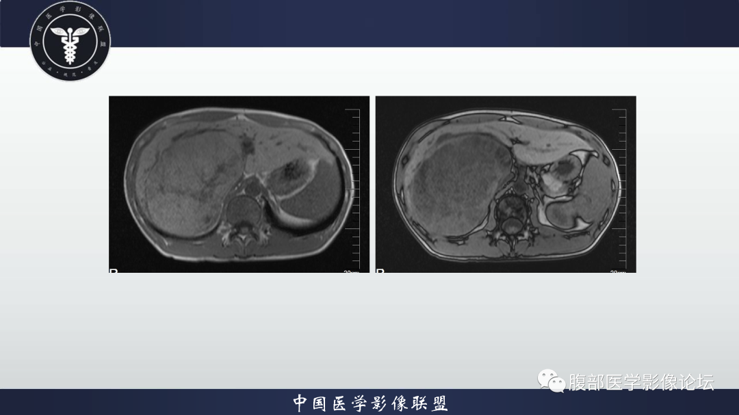 影像PPT - 【病例】肝细胞腺瘤1例CT及MR影像诊断-7