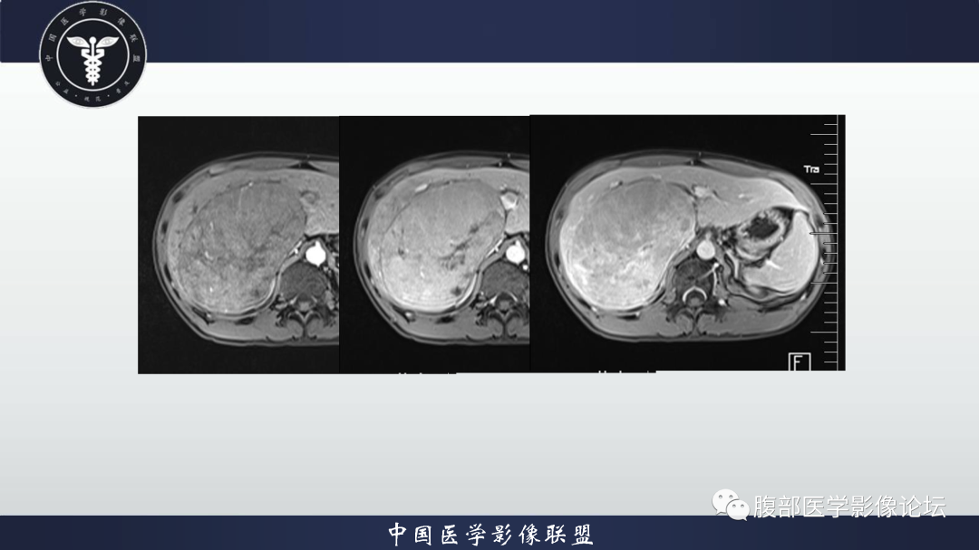 影像PPT - 【病例】肝细胞腺瘤1例CT及MR影像诊断-8