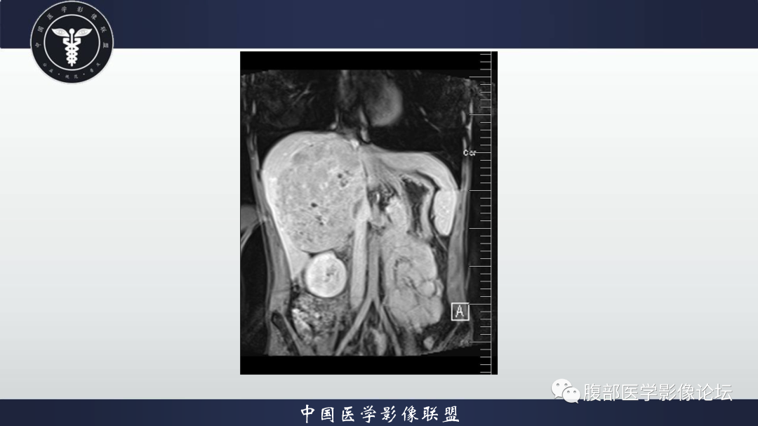 影像PPT - 【病例】肝细胞腺瘤1例CT及MR影像诊断-9