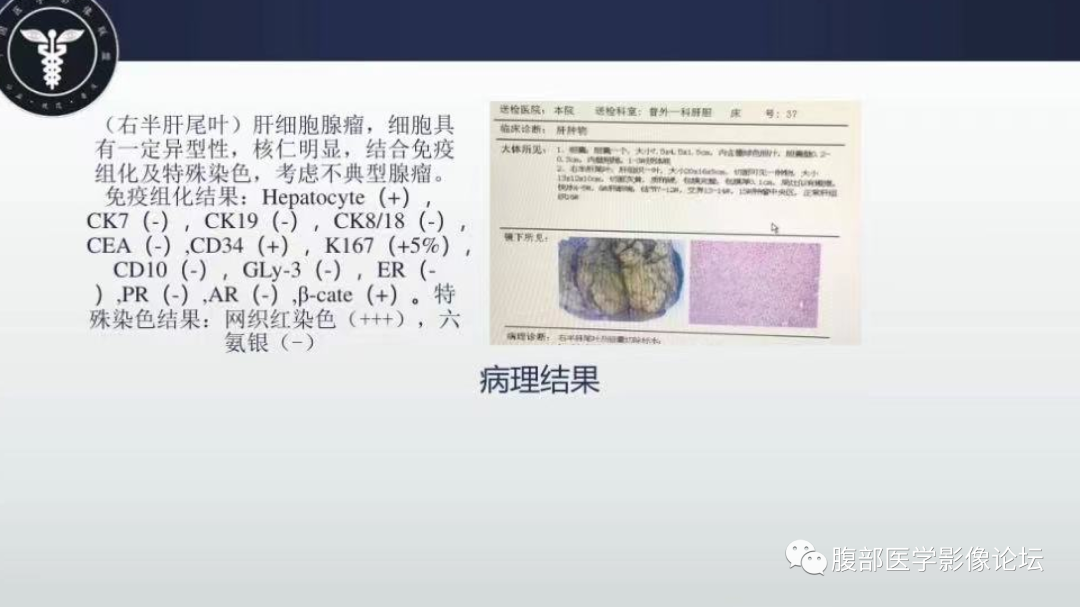影像PPT - 【病例】肝细胞腺瘤1例CT及MR影像诊断-10