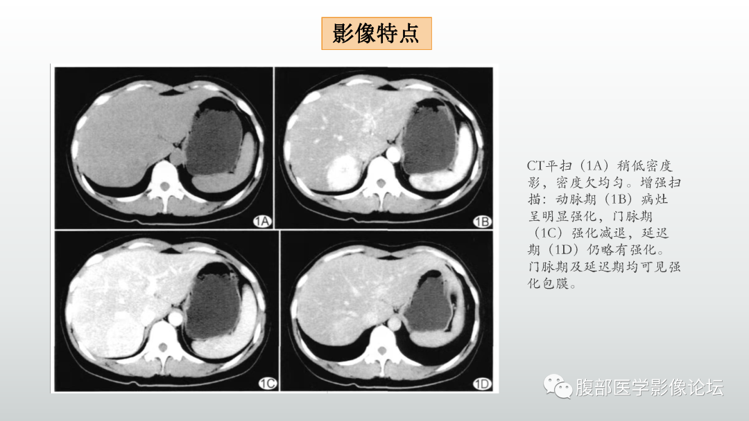 影像PPT - 【病例】肝细胞腺瘤1例CT及MR影像诊断-14