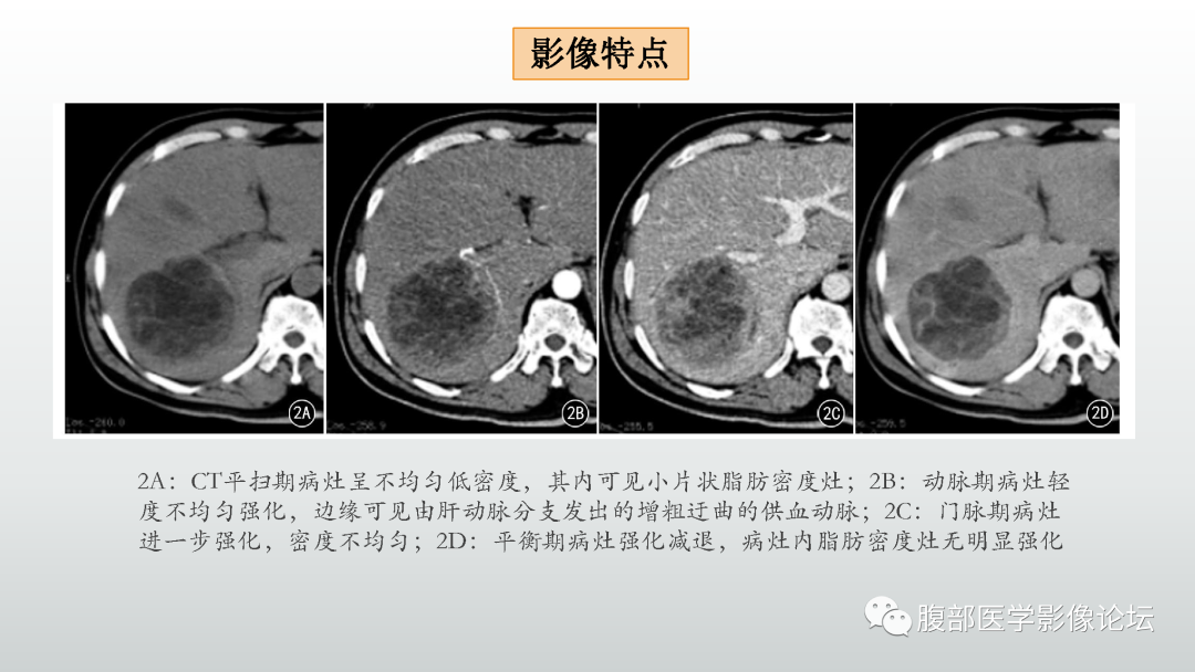 影像PPT - 【病例】肝细胞腺瘤1例CT及MR影像诊断-15