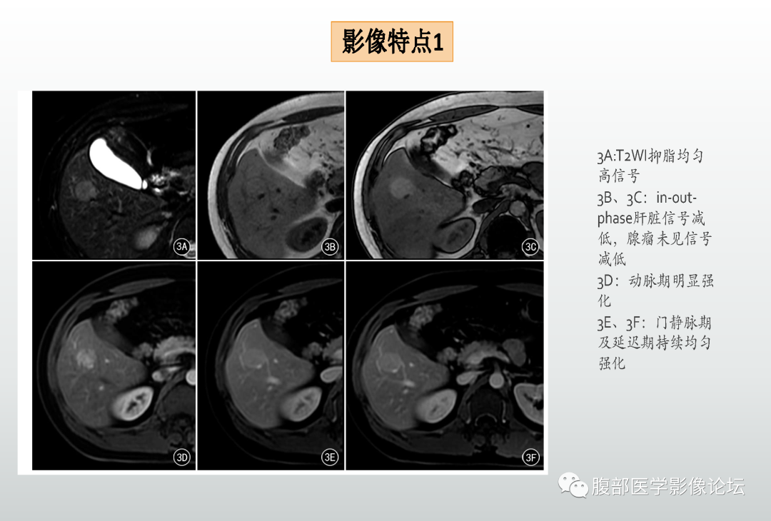 影像PPT - 【病例】肝细胞腺瘤1例CT及MR影像诊断-20