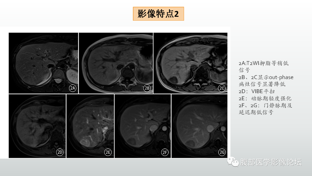 影像PPT - 【病例】肝细胞腺瘤1例CT及MR影像诊断-24