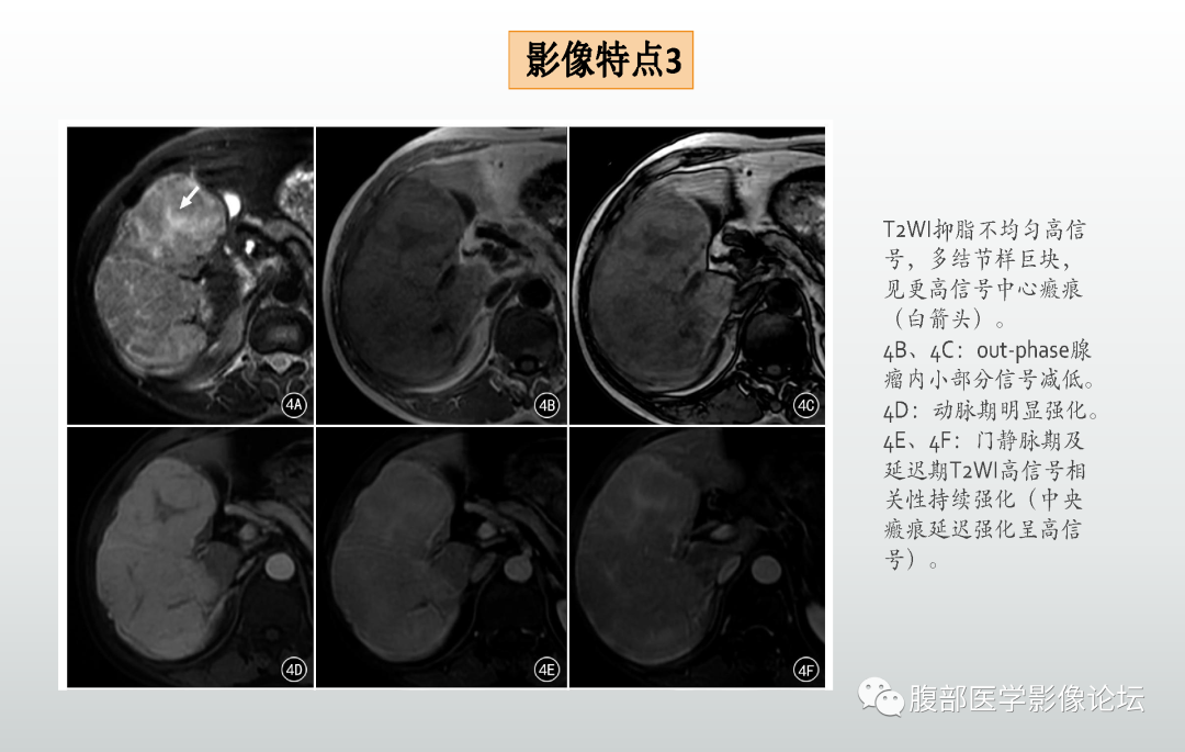 影像PPT - 【病例】肝细胞腺瘤1例CT及MR影像诊断-27
