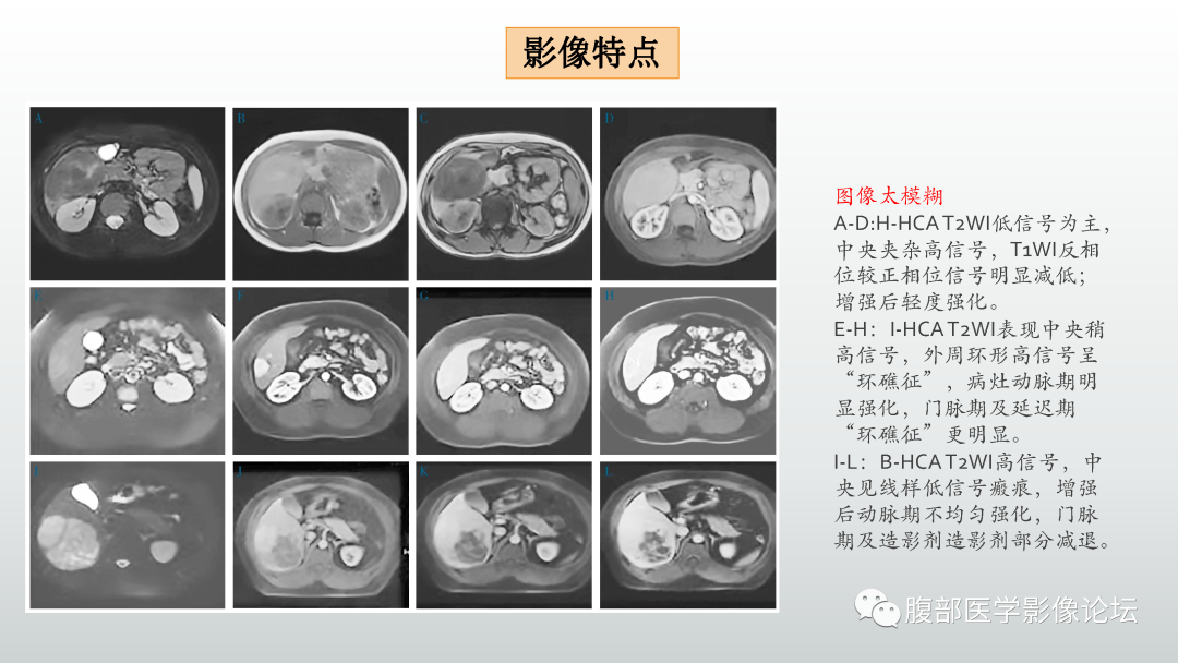 影像PPT - 【病例】肝细胞腺瘤1例CT及MR影像诊断-30