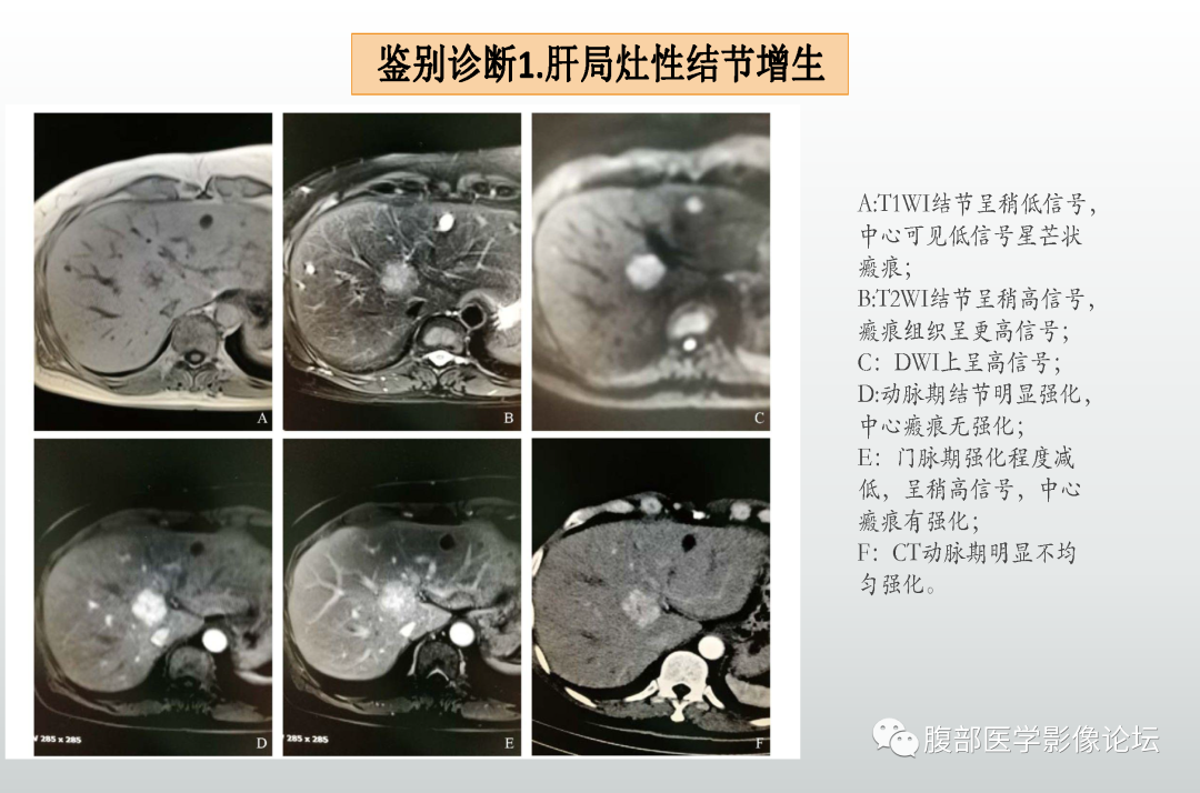 影像PPT - 【病例】肝细胞腺瘤1例CT及MR影像诊断-35