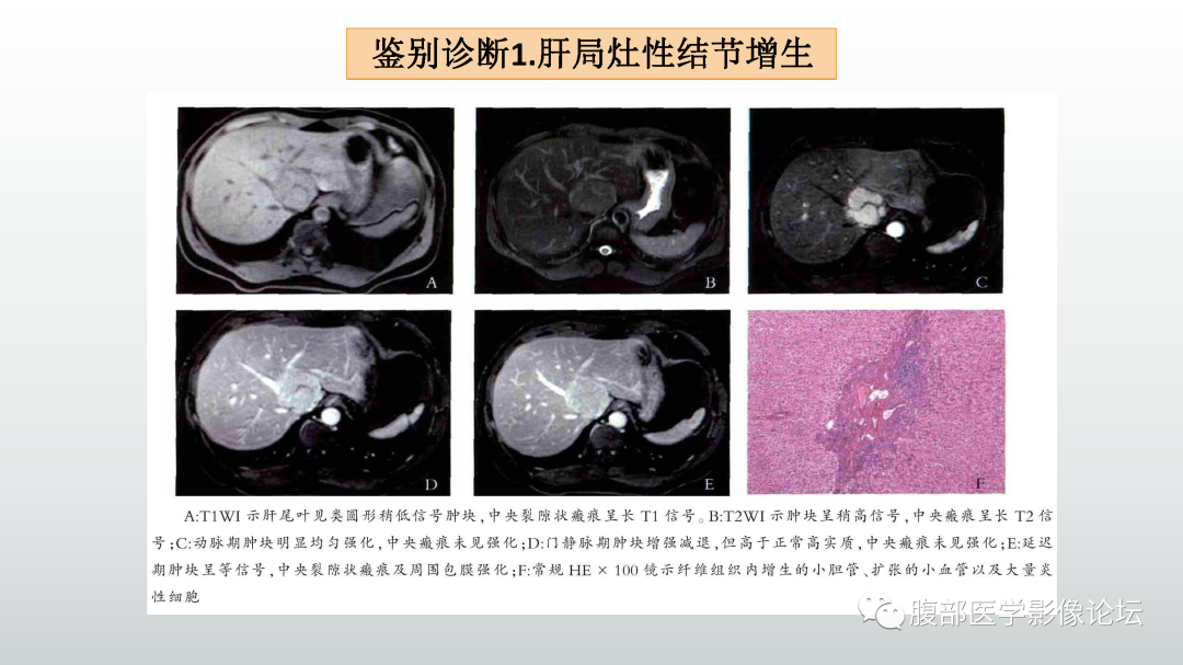 影像PPT - 【病例】肝细胞腺瘤1例CT及MR影像诊断-36