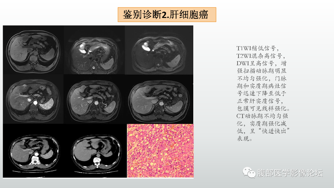 影像PPT - 【病例】肝细胞腺瘤1例CT及MR影像诊断-39
