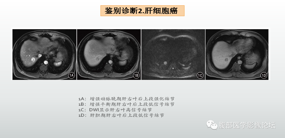 影像PPT - 【病例】肝细胞腺瘤1例CT及MR影像诊断-40