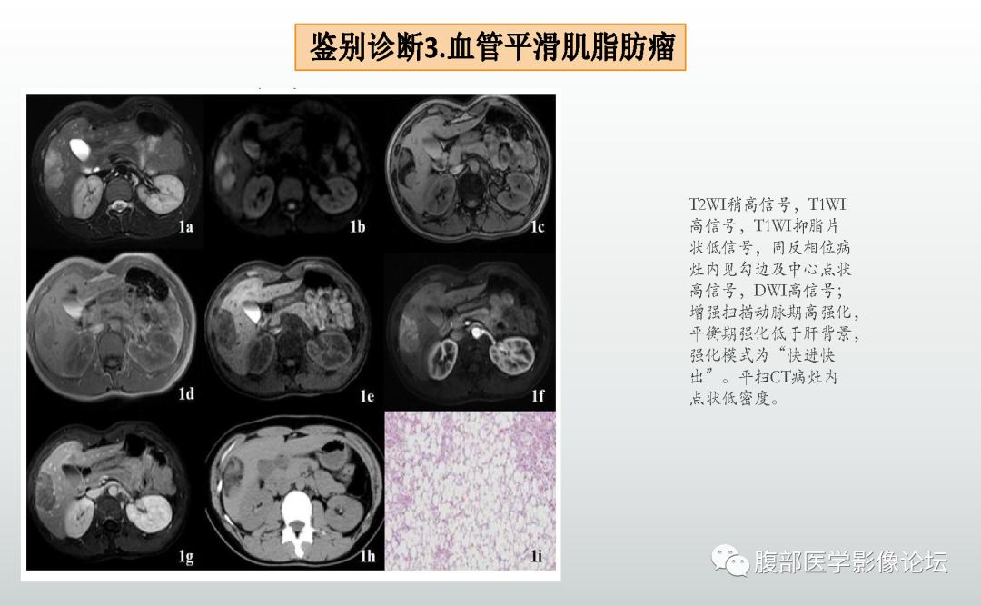 影像PPT - 【病例】肝细胞腺瘤1例CT及MR影像诊断-43