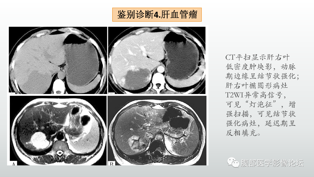 影像PPT - 【病例】肝细胞腺瘤1例CT及MR影像诊断-46