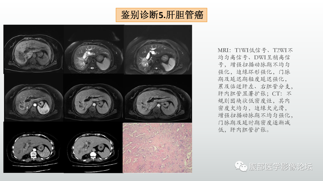 影像PPT - 【病例】肝细胞腺瘤1例CT及MR影像诊断-49