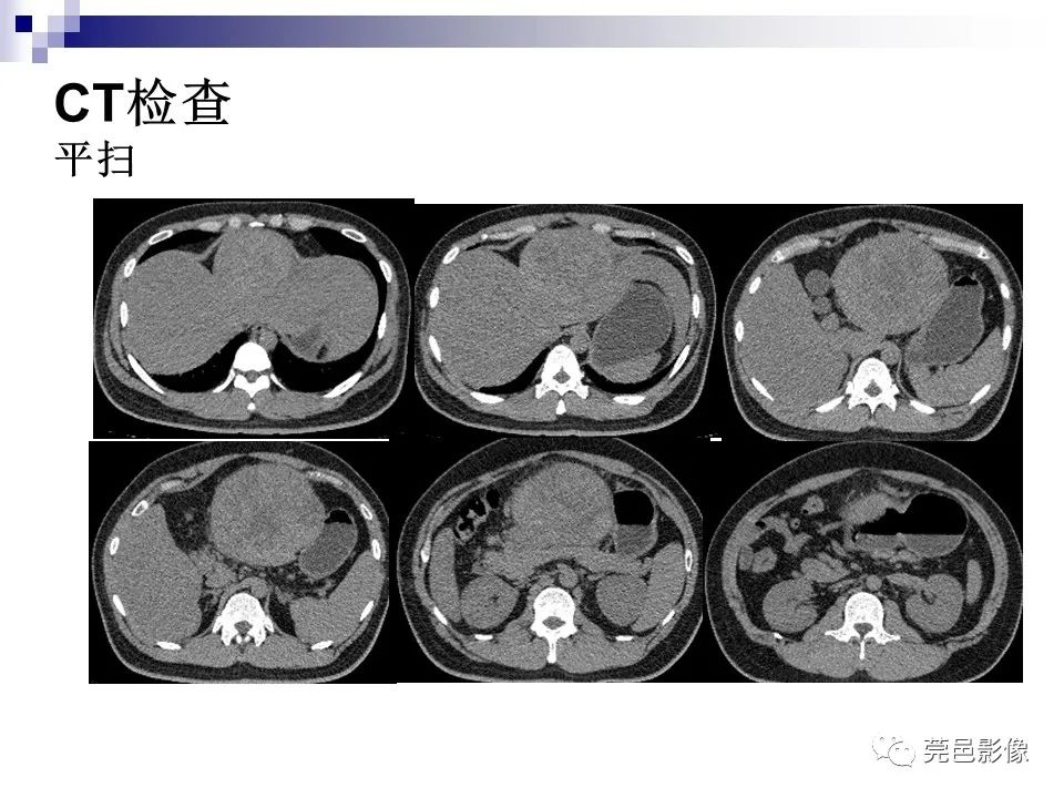 影像PPT - 【PPT】一例少见巨块外生型肝癌CT诊断及文献学习-3