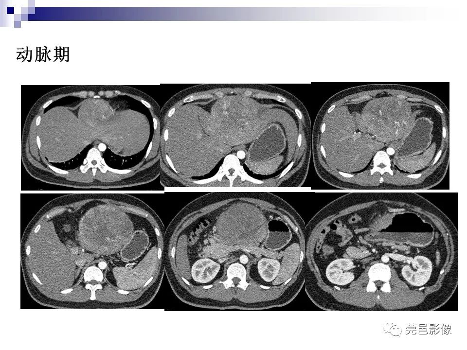影像PPT - 【PPT】一例少见巨块外生型肝癌CT诊断及文献学习-4
