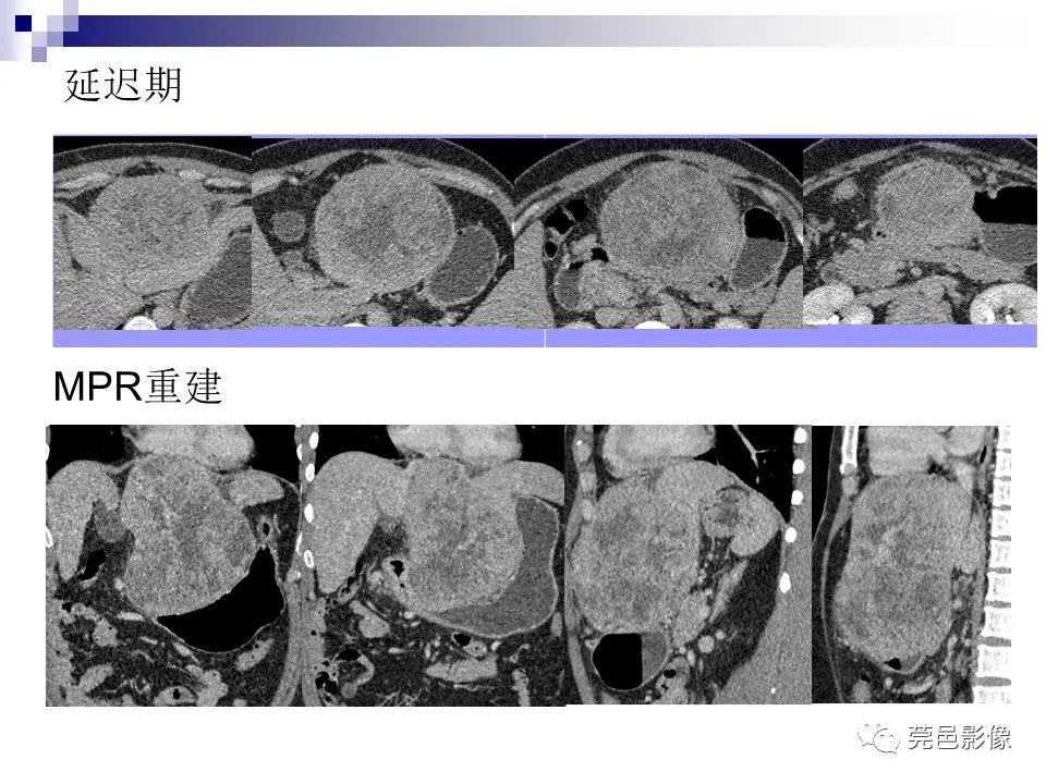 影像PPT - 【PPT】一例少见巨块外生型肝癌CT诊断及文献学习-6