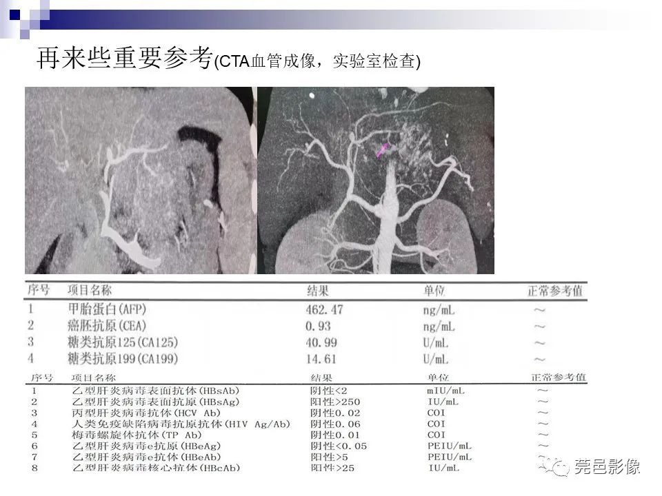 影像PPT - 【PPT】一例少见巨块外生型肝癌CT诊断及文献学习-8