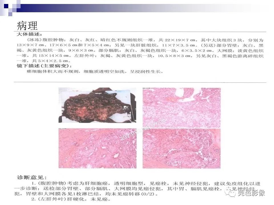 影像PPT - 【PPT】一例少见巨块外生型肝癌CT诊断及文献学习-11