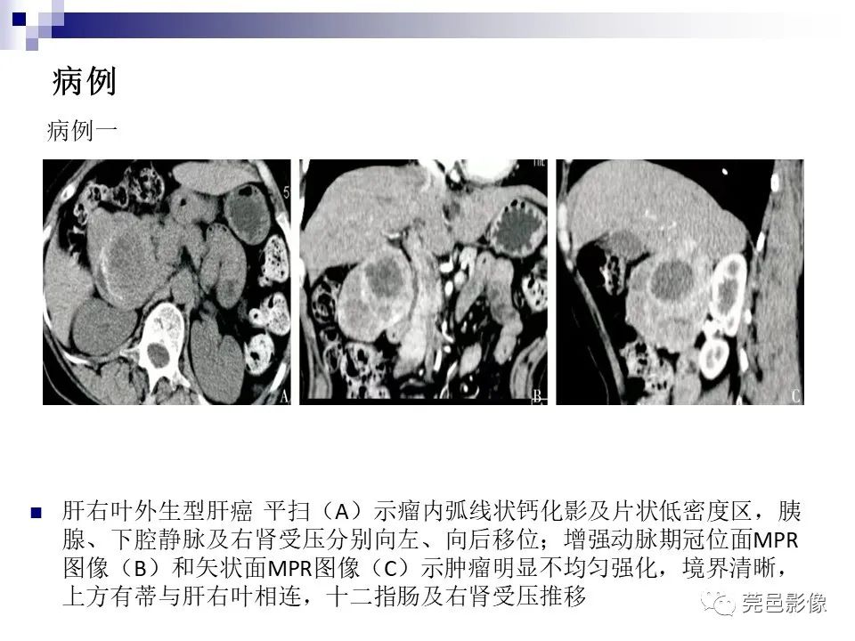 影像PPT - 【PPT】一例少见巨块外生型肝癌CT诊断及文献学习-17