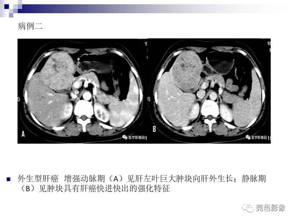 影像PPT - 【PPT】一例少见巨块外生型肝癌CT诊断及文献学习-18