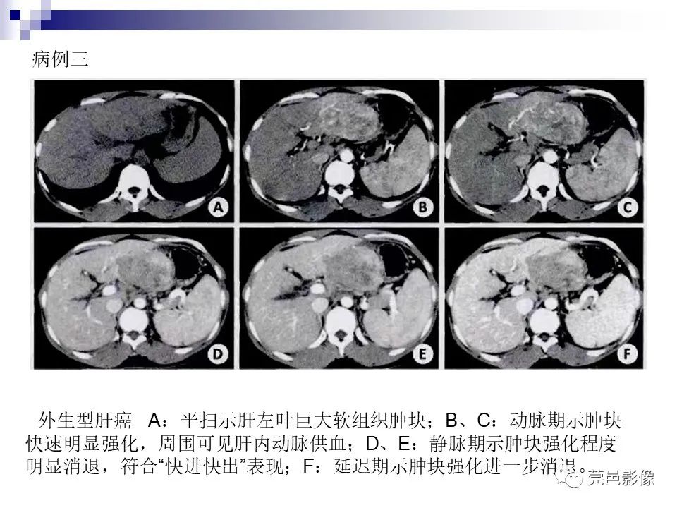 影像PPT - 【PPT】一例少见巨块外生型肝癌CT诊断及文献学习-19