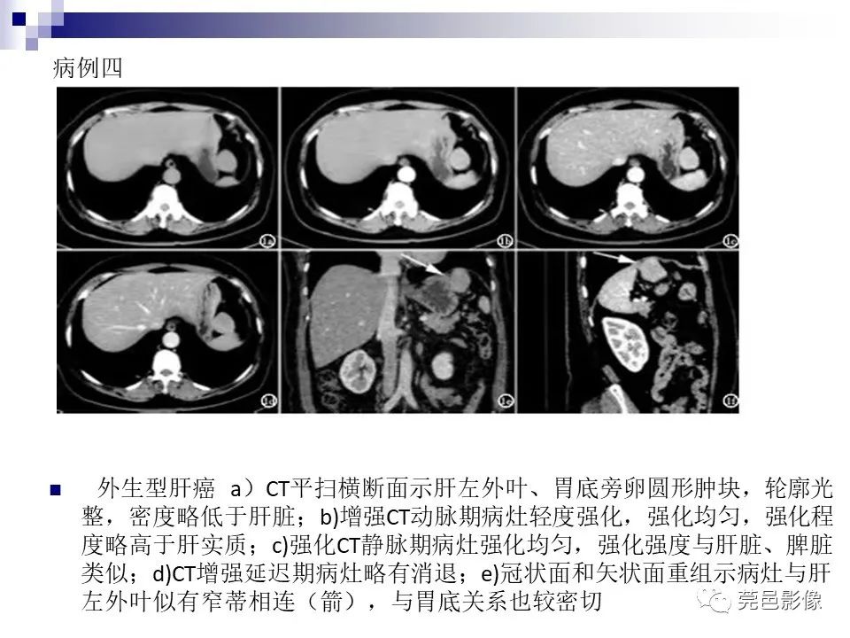 影像PPT - 【PPT】一例少见巨块外生型肝癌CT诊断及文献学习-20